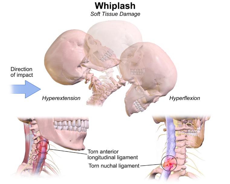 Car Accident Whiplash Neck Injury Physical Therapy
