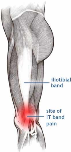 IT band Iliotibial pain runners knee bozeman