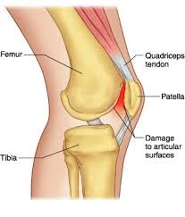 Knee Quadriceps Quad Patellofemoral Brace