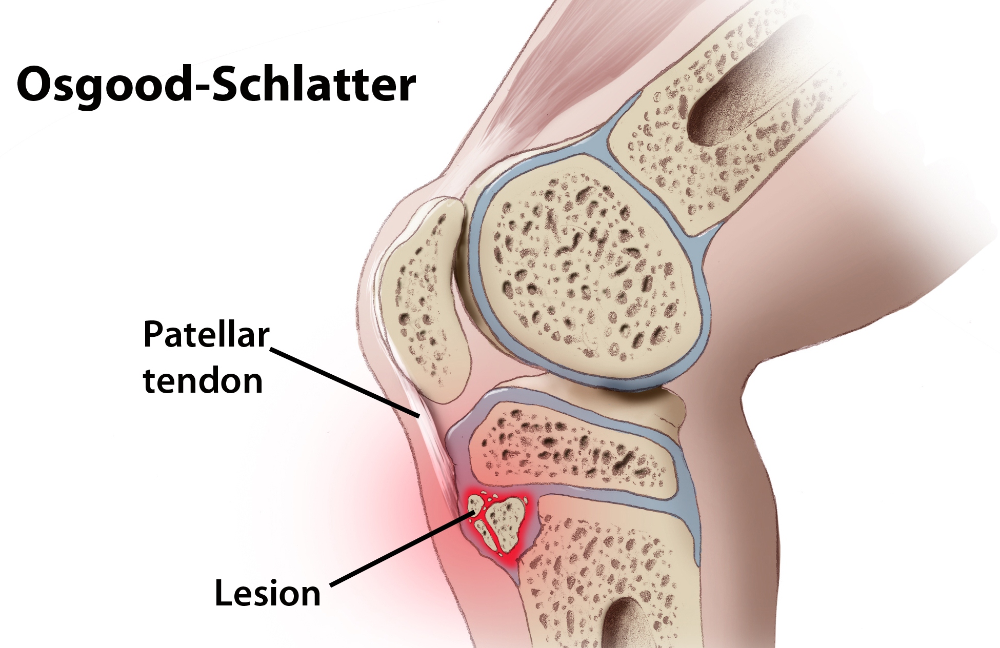 Osgood Schlatter Disease in Adults: Treatment for Knee Pain