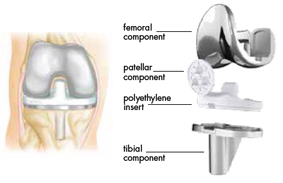 Total Knee Replacement Components